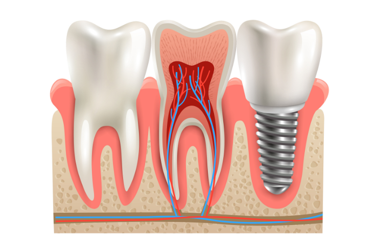 Dental Implants
